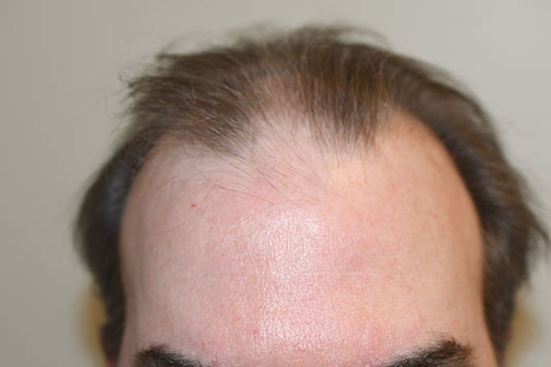 Hair Restoration for Men Before & After Gallery - Patient 147631 - Image 1