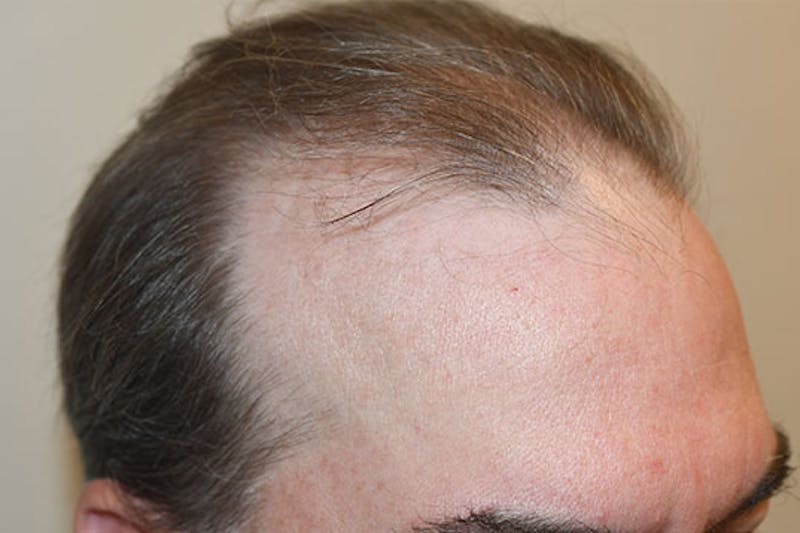 Hair Restoration for Men Before & After Gallery - Patient 147631 - Image 3