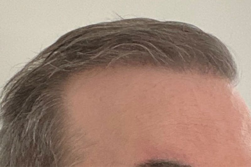 Hair Restoration for Men Before & After Gallery - Patient 147631 - Image 4