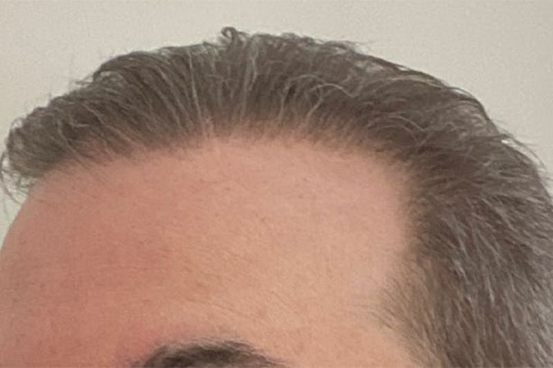 Hair Restoration for Men Before & After Gallery - Patient 147631 - Image 6