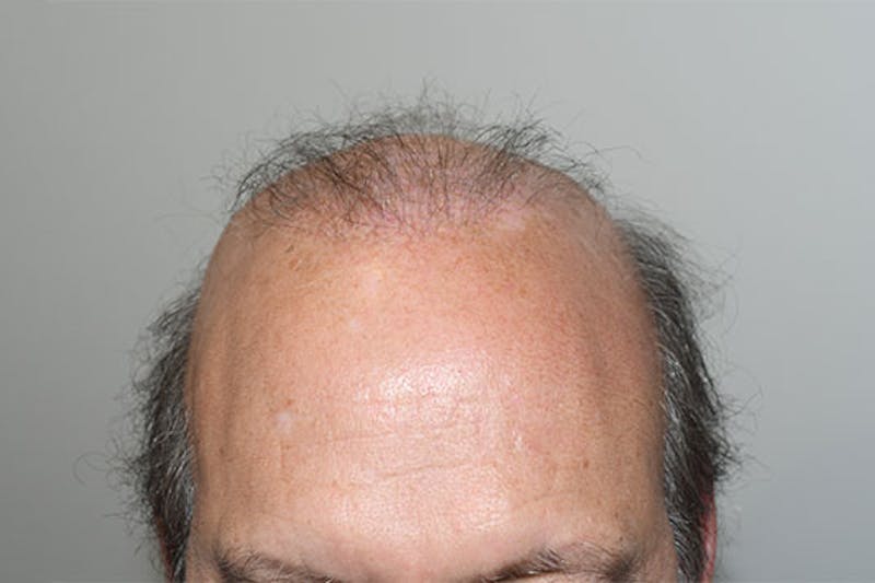 Hair Restoration for Men Before & After Gallery - Patient 681829 - Image 1