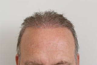 Hair Restoration for Men Before & After Gallery - Patient 681829 - Image 2