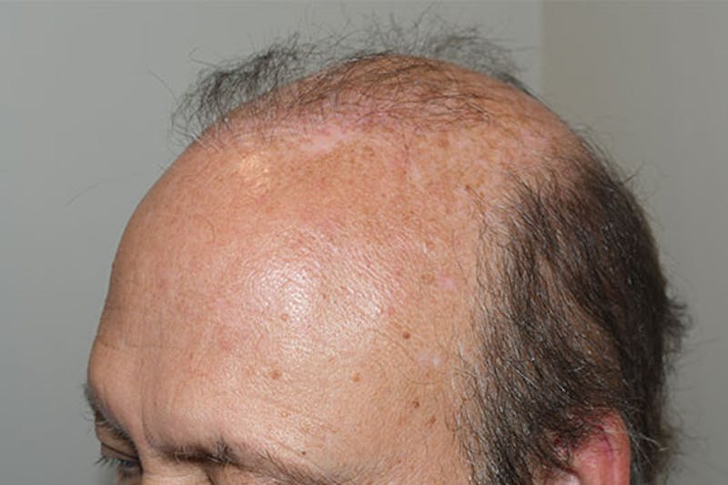 Hair Restoration for Men Before & After Gallery - Patient 681829 - Image 3