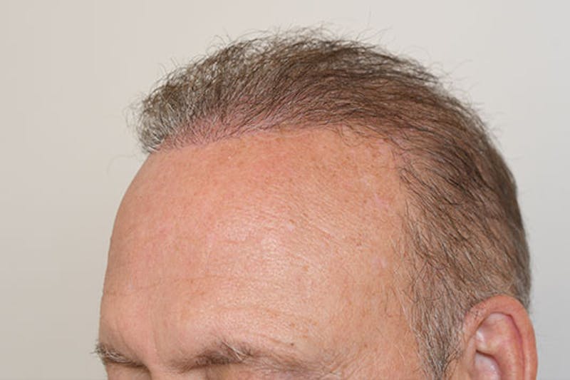 Hair Restoration for Men Before & After Gallery - Patient 681829 - Image 4