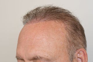 Hair Restoration for Men Before & After Gallery - Patient 681829 - Image 4