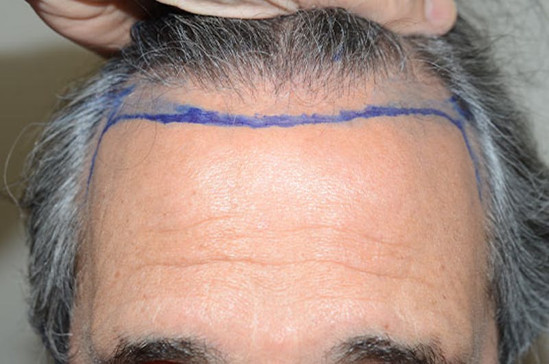Hair Restoration for Men Before & After Gallery - Patient 255285 - Image 1