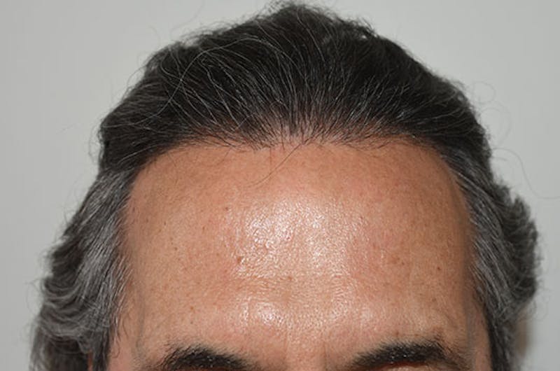 Hair Restoration for Men Before & After Gallery - Patient 255285 - Image 2