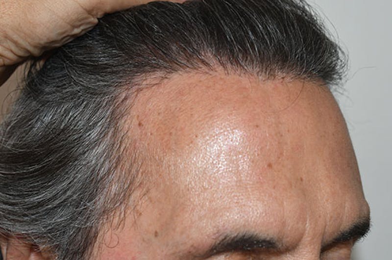 Hair Restoration for Men Before & After Gallery - Patient 255285 - Image 4