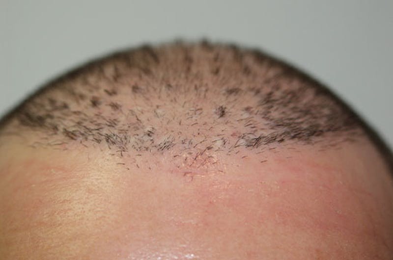 Hair Restoration for Men Before & After Gallery - Patient 121824 - Image 1