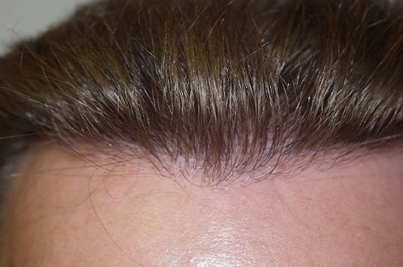 Hair Restoration for Men Before & After Gallery - Patient 121824 - Image 2
