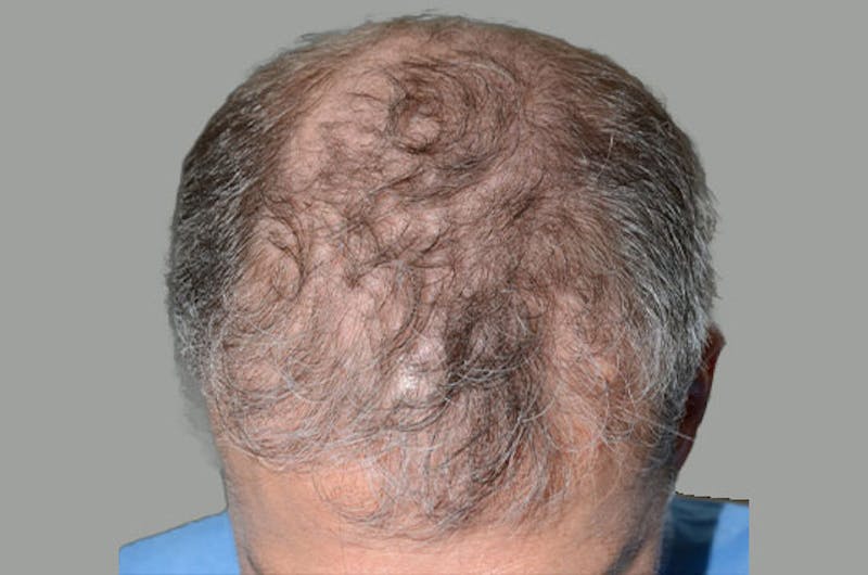 Hair Restoration for Men Before & After Gallery - Patient 362030 - Image 1