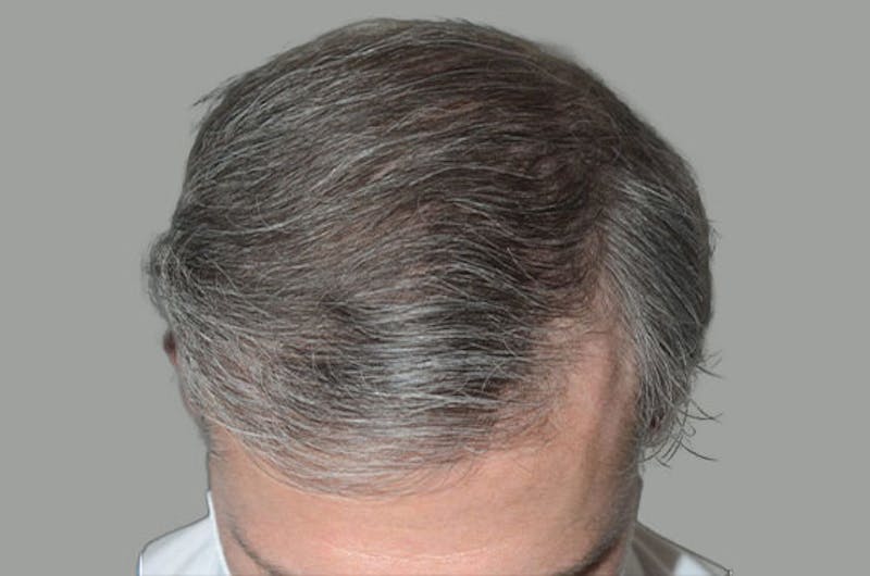 Hair Restoration for Men Before & After Gallery - Patient 362030 - Image 2