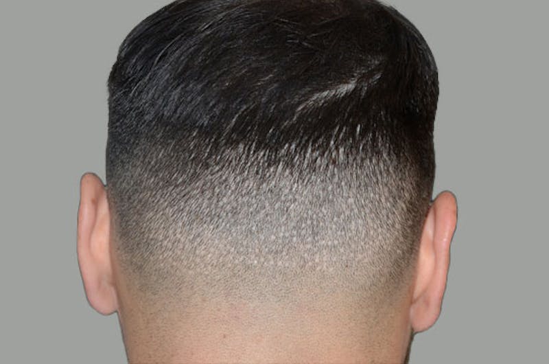 Hair Restoration for Men Before & After Gallery - Patient 797340 - Image 1