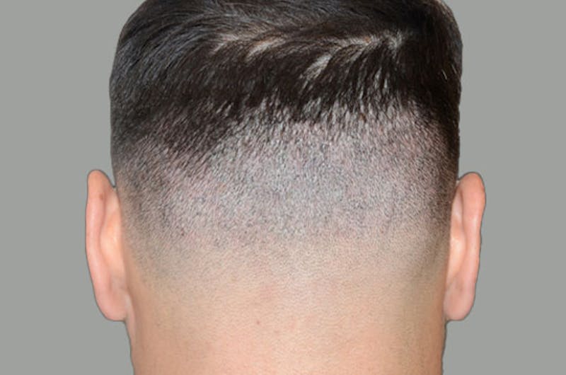 Hair Restoration for Men Before & After Gallery - Patient 797340 - Image 2