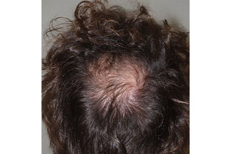Hair Restoration for Men Before & After Gallery - Patient 286780 - Image 1