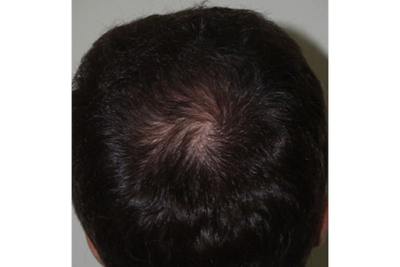 Hair Restoration for Men Before & After Gallery - Patient 286780 - Image 2