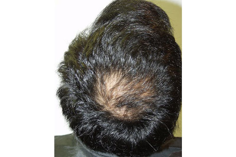 Hair Restoration for Men Before & After Gallery - Patient 353490 - Image 1