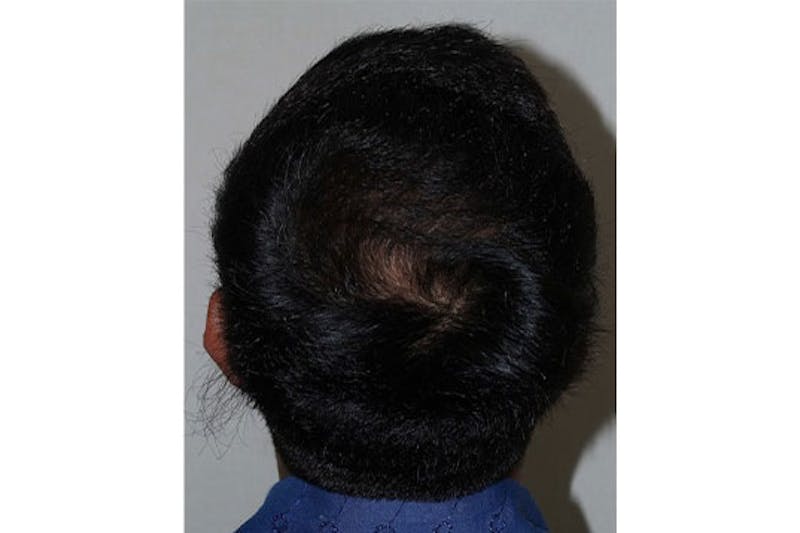 Hair Restoration for Men Before & After Gallery - Patient 353490 - Image 2
