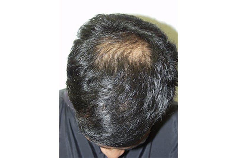 Hair Restoration for Men Before & After Gallery - Patient 353490 - Image 3