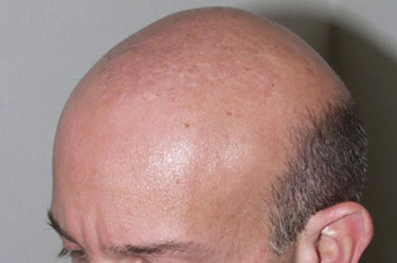 Hair Restoration for Men Before & After Gallery - Patient 831519 - Image 2