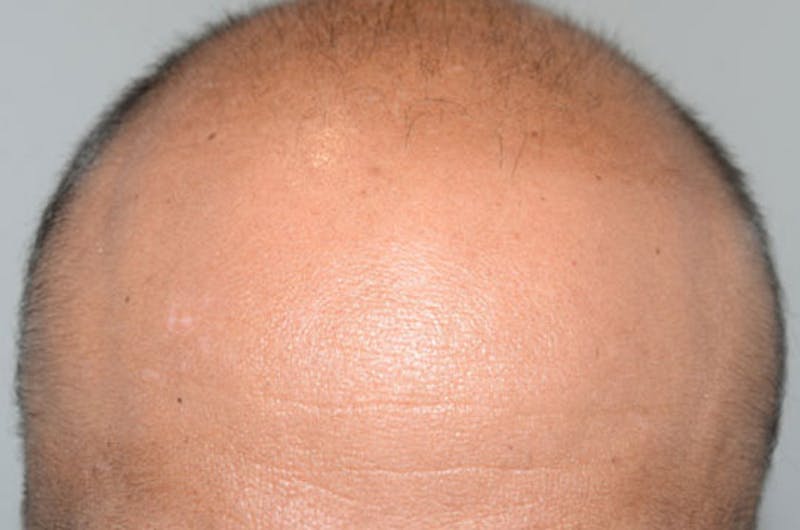 Hair Restoration for Men Before & After Gallery - Patient 238173 - Image 1