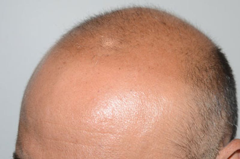 Hair Restoration for Men Before & After Gallery - Patient 238173 - Image 3