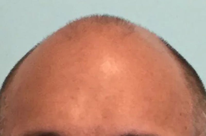 Hair Restoration for Men Before & After Gallery - Patient 243413 - Image 1