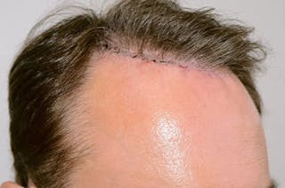 Hair Restoration for Men Before & After Gallery - Patient 646090 - Image 4