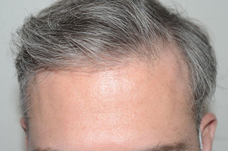 Hair Restoration for Men Before & After Gallery - Patient 362030 - Image 4