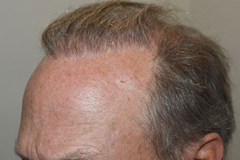 Hair Transplant Repair Before & After Gallery - Patient 133153 - Image 1