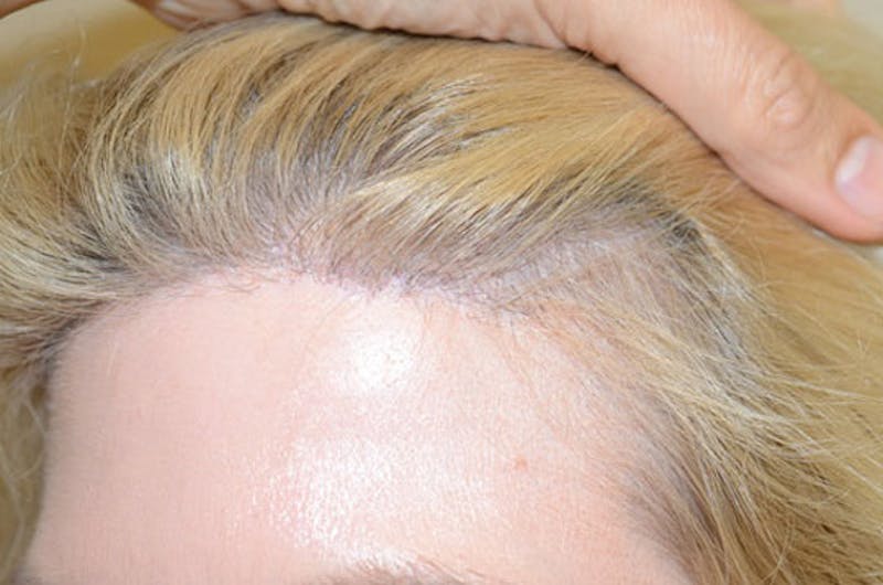 Hair Transplant Repair Before & After Gallery - Patient 111679 - Image 4