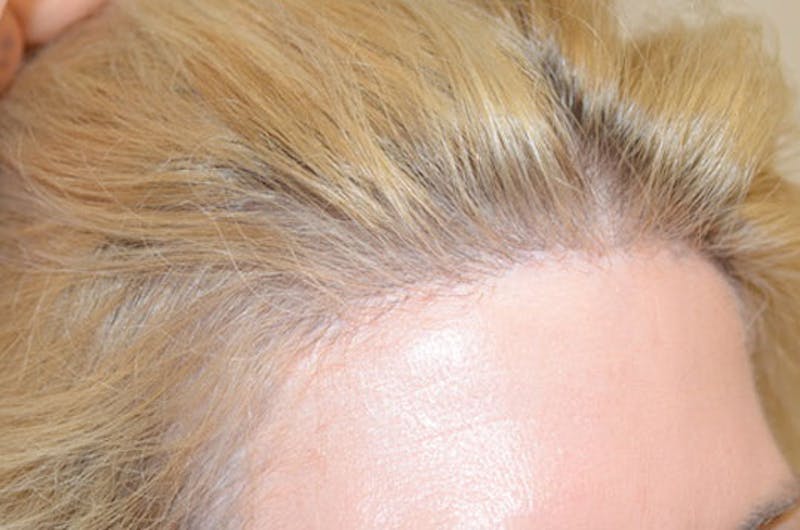 Hair Transplant Repair Before & After Gallery - Patient 111679 - Image 6