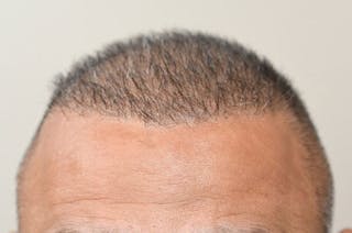 Hair Transplant Repair Before & After Gallery - Patient 104465 - Image 2