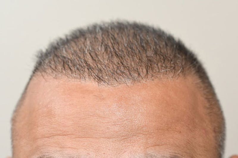 Hair Transplant Repair Before & After Gallery - Patient 104465 - Image 2