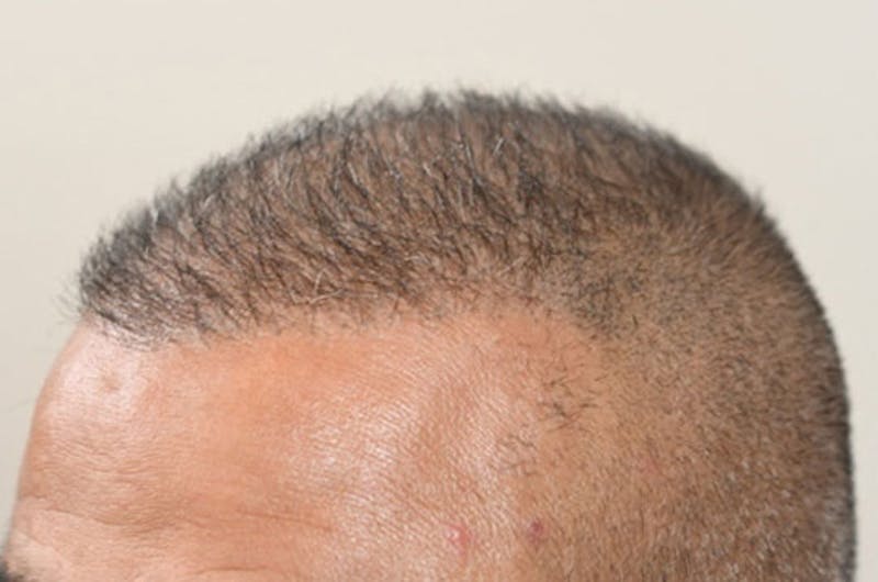Hair Transplant Repair Before & After Gallery - Patient 104465 - Image 4