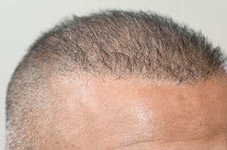 Hair Transplant Repair Before & After Gallery - Patient 104465 - Image 6