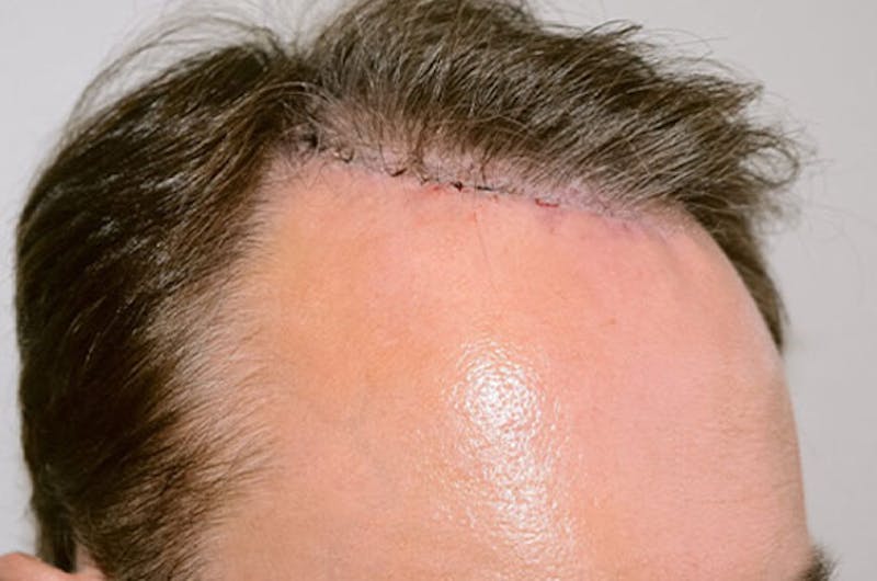 Hair Transplant Repair Before & After Gallery - Patient 915052 - Image 4