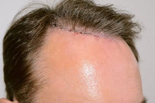 Hair Transplant Repair Before & After Gallery - Patient 915052 - Image 4