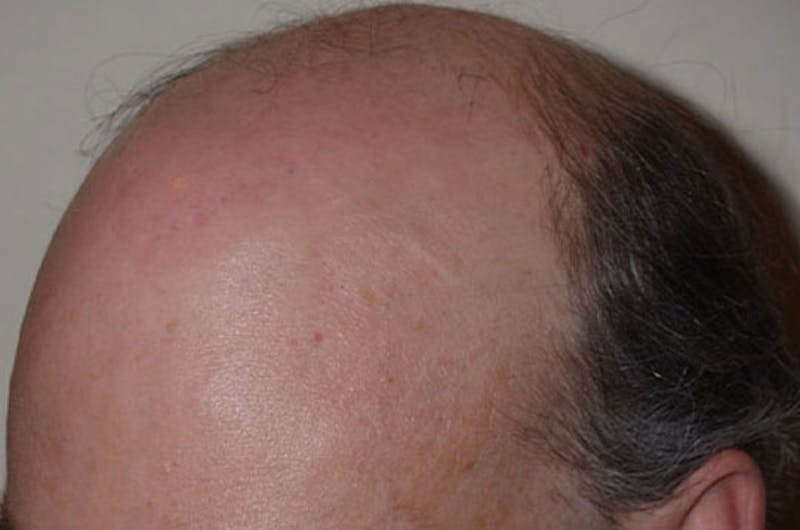 Hair Transplant Repair Before & After Gallery - Patient 375594 - Image 10