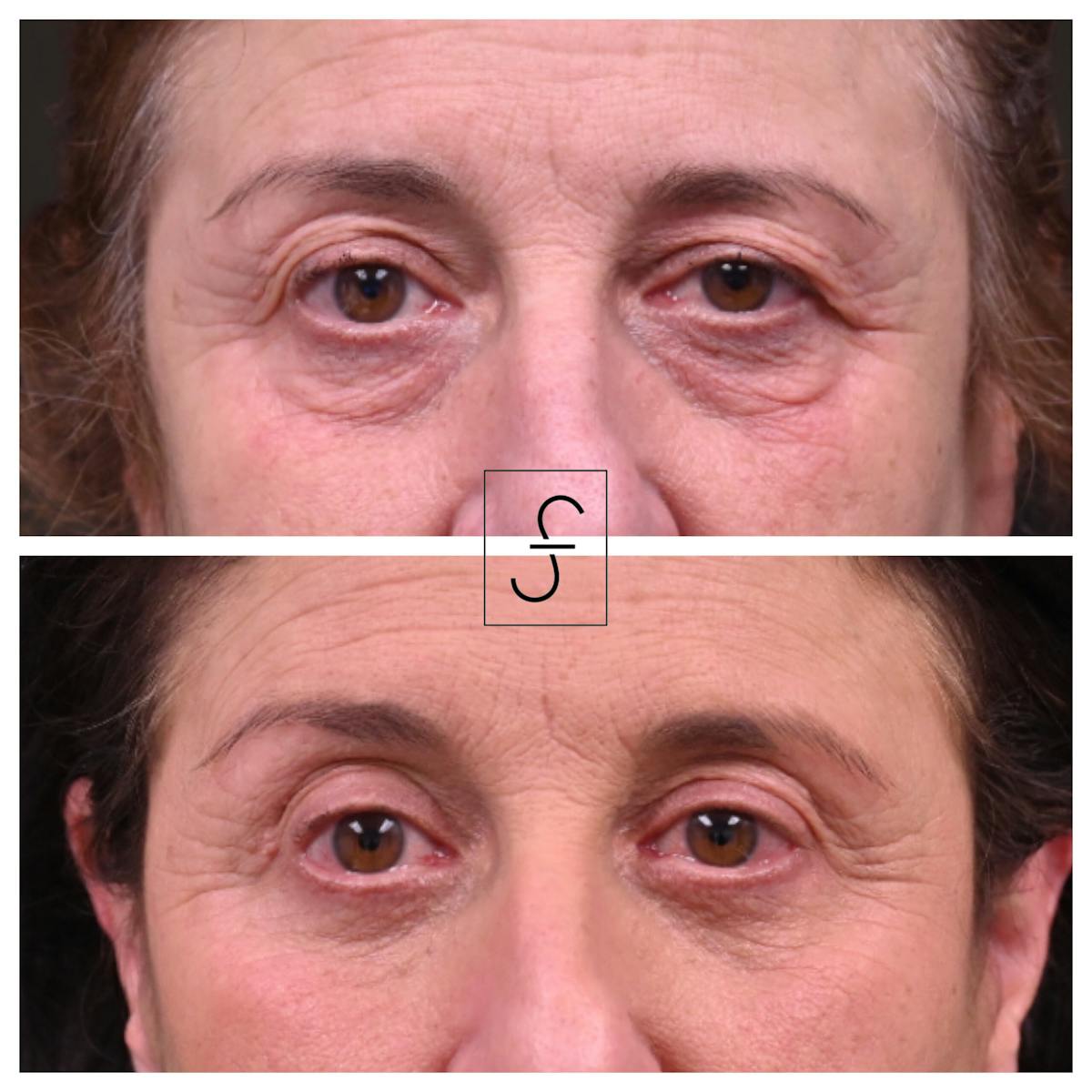 Blepharoplasty (Eyelid Surgery) Before & After Gallery - Patient 540433 - Image 1