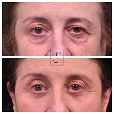 Blepharoplasty (Eyelid Surgery) Before & After Gallery - Patient 540433 - Image 1