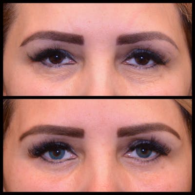 Blepharoplasty (Eyelid Surgery) Before & After Gallery - Patient 274761 - Image 1