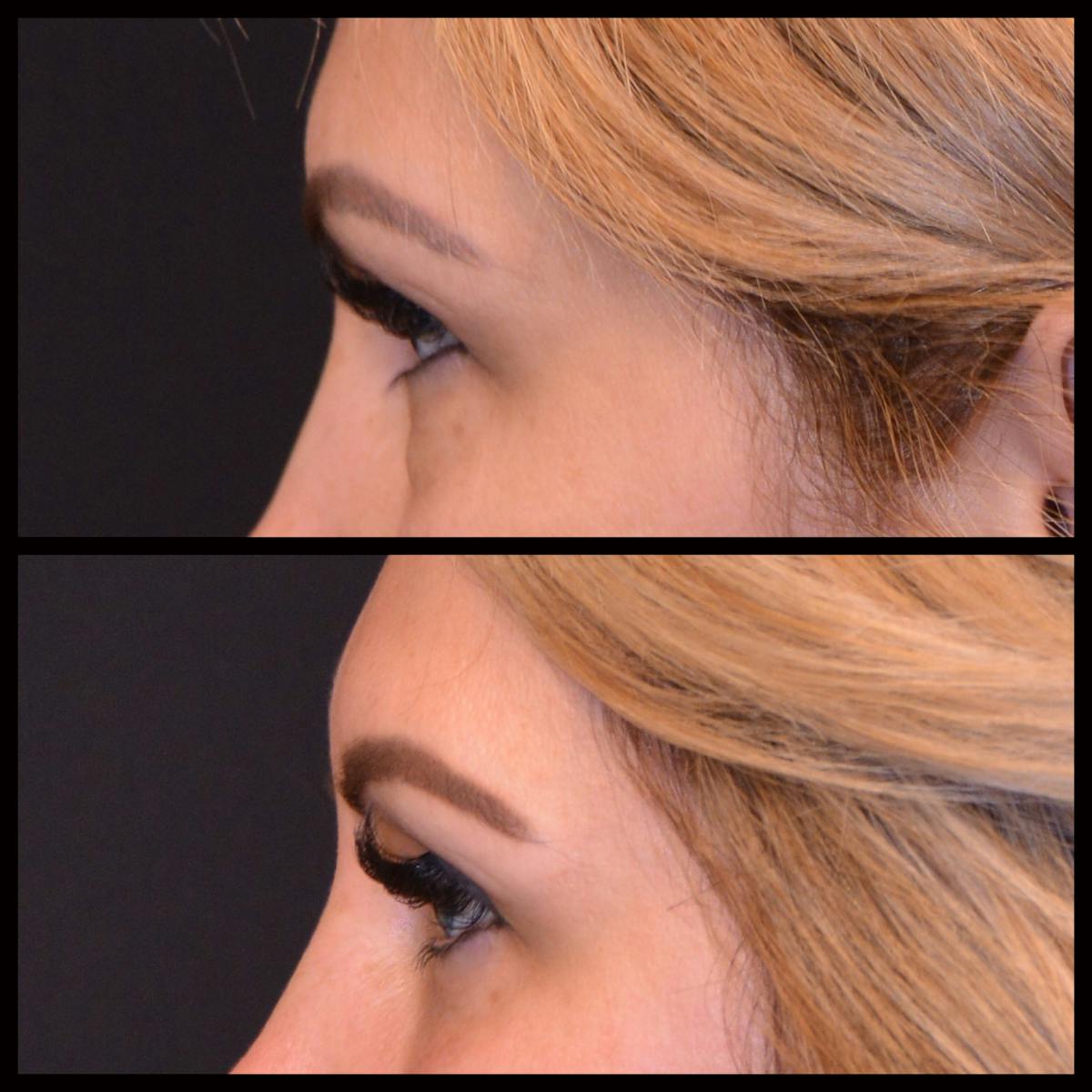 Blepharoplasty (Eyelid Surgery) Before & After Gallery - Patient 125478 - Image 1