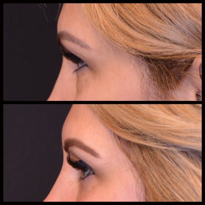 Blepharoplasty (Eyelid Surgery) Before & After Gallery - Patient 125478 - Image 1