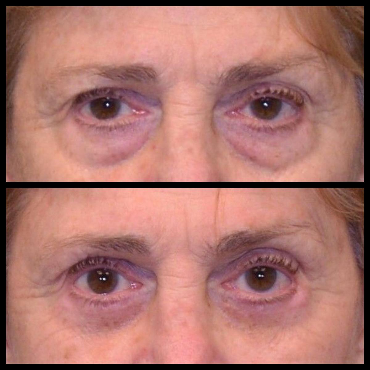 Blepharoplasty (Eyelid Surgery) Before & After Gallery - Patient 126627 - Image 1