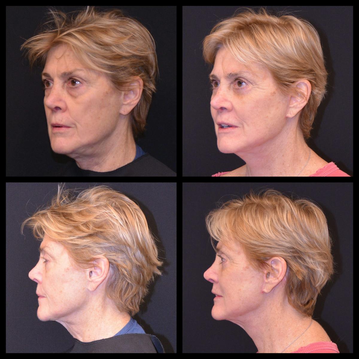Blepharoplasty (Eyelid Surgery) Before & After Gallery - Patient 136930 - Image 1