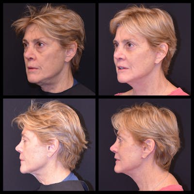 Blepharoplasty (Eyelid Surgery) Before & After Gallery - Patient 136930 - Image 1