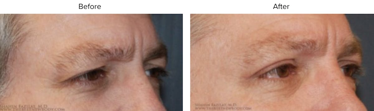 Blepharoplasty (Eyelid Surgery) Before & After Gallery - Patient 407392 - Image 2