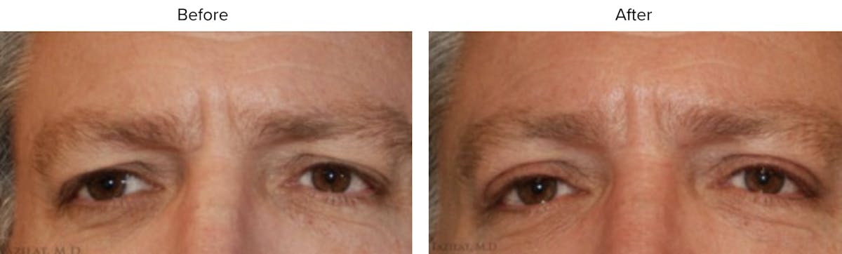 Blepharoplasty (Eyelid Surgery) Before & After Gallery - Patient 407392 - Image 1
