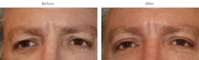 Blepharoplasty (Eyelid Surgery) Before & After Gallery - Patient 407392 - Image 1